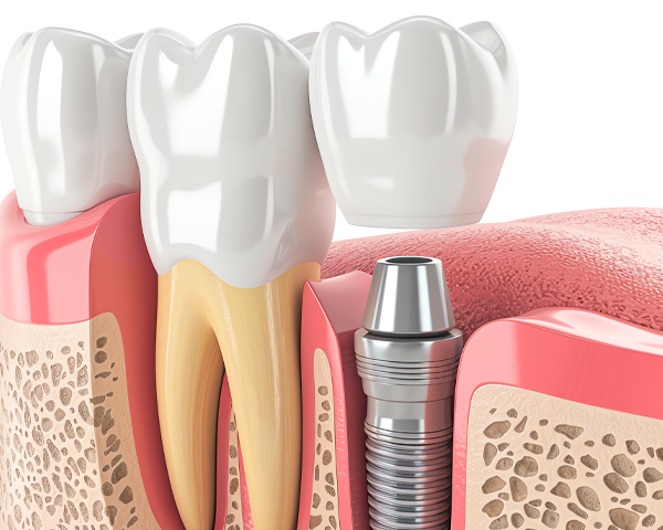 Imagem de um implante dentário mostrando a estrutura de titânio inserida no osso maxilar.