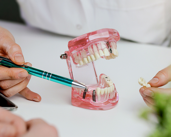 quais problemas dentários o implante resolve - Imagem dentista mostrando tecnologia de implante dentário no modelo de mandíbula dentária ao paciente. visita no consultório da clínica